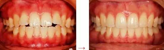 隱形矯正－牙齒矯正讓臉形變更美了