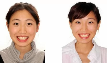 隱形矯正－牙齒矯正讓臉形變更美了