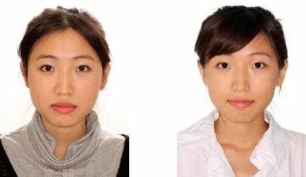 隱形矯正－牙齒矯正讓臉形變更美了