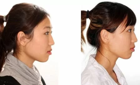 隱形矯正－牙齒矯正讓臉形變更美了