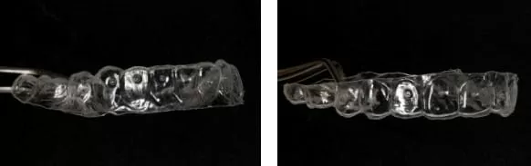 隱形矯正－牙齒矯正讓臉形變更美了