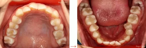 矯正牙齒,排列整齊恢復美觀與健康 矯正牙齒,排列整齊恢復美觀與健康
