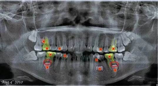 矯正牙齒,排列整齊恢復美觀與健康 矯正牙齒,排列整齊恢復美觀與健康
