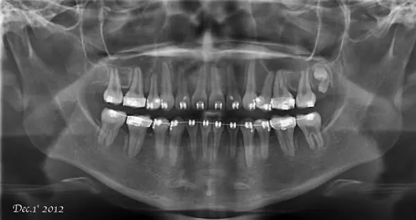 矯正牙齒,排列整齊恢復美觀與健康 矯正牙齒,排列整齊恢復美觀與健康