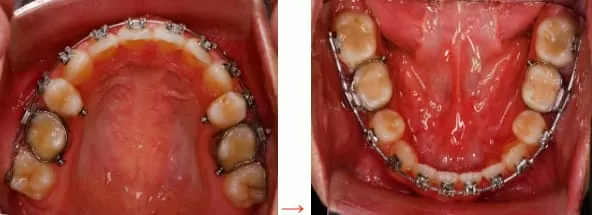 矯正牙齒,排列整齊恢復美觀與健康 矯正牙齒,排列整齊恢復美觀與健康
