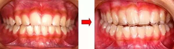 隱形矯正門牙暴牙與齒列不整 隱形矯正門牙暴牙與齒列不整