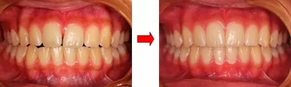 隱形矯正門牙暴牙與齒列不整 隱形矯正門牙暴牙與齒列不整