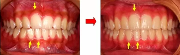 隱形矯正門牙暴牙與齒列不整 隱形矯正門牙暴牙與齒列不整