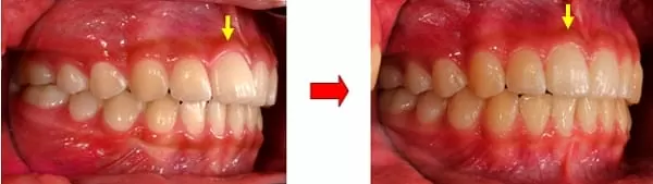隱形矯正門牙暴牙與齒列不整 隱形矯正門牙暴牙與齒列不整