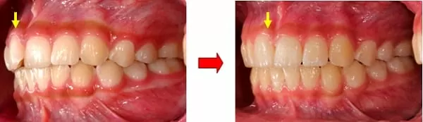 隱形矯正門牙暴牙與齒列不整 隱形矯正門牙暴牙與齒列不整