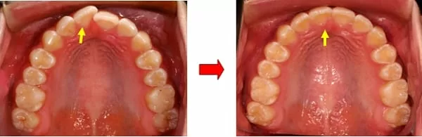 隱形矯正門牙暴牙與齒列不整 隱形矯正門牙暴牙與齒列不整