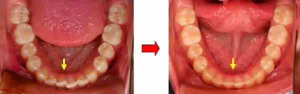 隱形矯正門牙暴牙與齒列不整 隱形矯正門牙暴牙與齒列不整