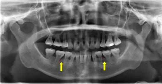 牙周病所引發的嚴重齒槽骨侵蝕與流失