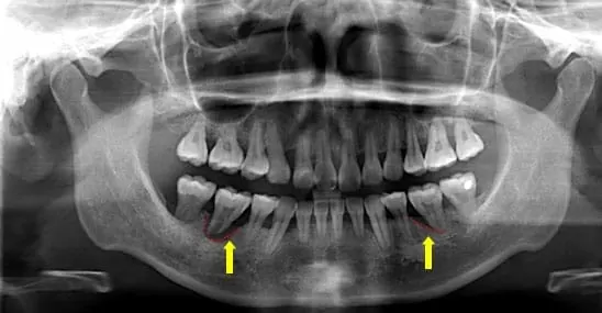 牙周病所引發的嚴重齒槽骨侵蝕與流失