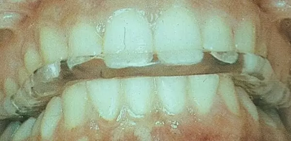 我不是「國字臉」,我只是咬肌肥大 我不是「國字臉」,我只是咬肌肥大