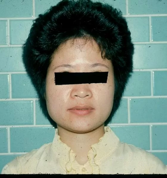 我不是「國字臉」,我只是咬肌肥大 我不是「國字臉」,我只是咬肌肥大