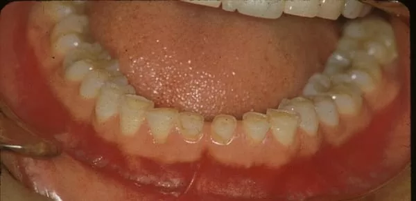 我不是「國字臉」,我只是咬肌肥大 我不是「國字臉」,我只是咬肌肥大