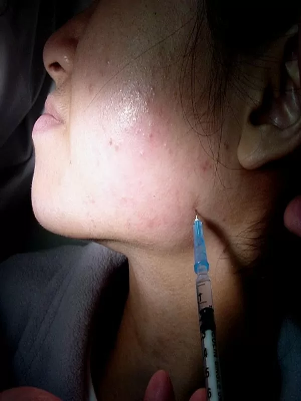 我不是「國字臉」,我只是咬肌肥大 我不是「國字臉」,我只是咬肌肥大