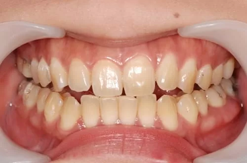 四環黴素造成黃板牙，牙齒美容展現亮麗齒色