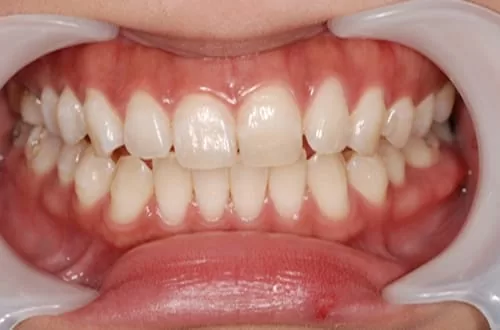 四環黴素造成黃板牙，牙齒美容展現亮麗齒色