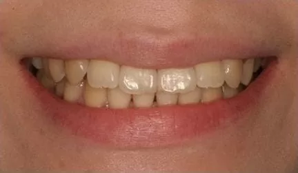 【市售美白產品】造成牙齒酸軟敏感 【市售美白產品】造成牙齒酸軟敏感