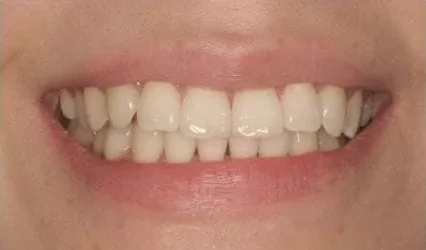 【市售美白產品】造成牙齒酸軟敏感 【市售美白產品】造成牙齒酸軟敏感