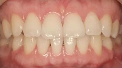 【市售美白產品】造成牙齒酸軟敏感 【市售美白產品】造成牙齒酸軟敏感