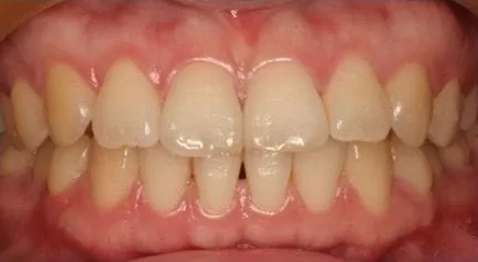 【市售美白產品】造成牙齒酸軟敏感 【市售美白產品】造成牙齒酸軟敏感