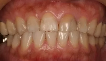 【我快要結婚了】準備拍婚紗照，想要一口潔白的牙齒