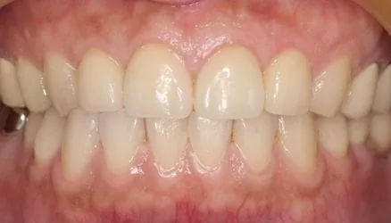 【我快要結婚了】準備拍婚紗照，想要一口潔白的牙齒