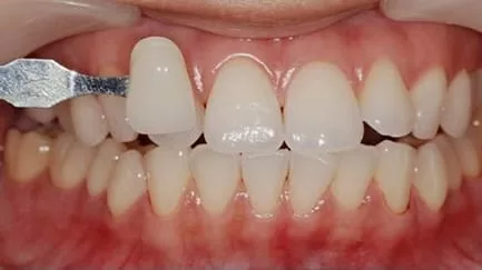 想永保潔白牙齒? 居家美白解決您的問題 想永保潔白牙齒? 居家美白解決您的問題