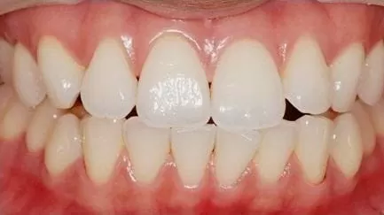 想永保潔白牙齒? 居家美白解決您的問題 想永保潔白牙齒? 居家美白解決您的問題