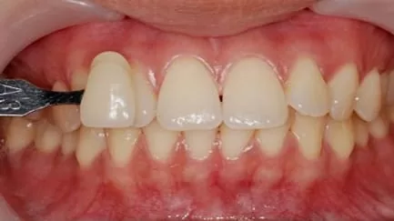 想永保潔白牙齒? 居家美白解決您的問題 想永保潔白牙齒? 居家美白解決您的問題