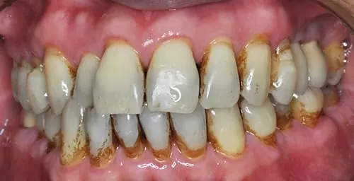 食物、抽菸留下的色素和汙垢 洗牙洗得掉嗎? 食物、抽菸留下的色素和汙垢 洗牙洗得掉嗎?