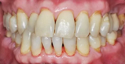 食物、抽菸留下的色素和汙垢 洗牙洗得掉嗎? 食物、抽菸留下的色素和汙垢 洗牙洗得掉嗎?