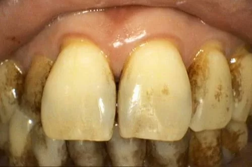 食物、抽菸留下的色素和汙垢 洗牙洗得掉嗎? 食物、抽菸留下的色素和汙垢 洗牙洗得掉嗎?