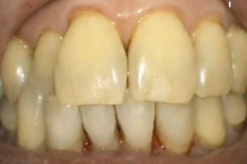 食物、抽菸留下的色素和汙垢 洗牙洗得掉嗎? 食物、抽菸留下的色素和汙垢 洗牙洗得掉嗎?