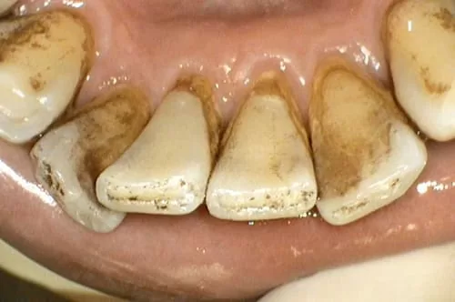 食物、抽菸留下的色素和汙垢 洗牙洗得掉嗎? 食物、抽菸留下的色素和汙垢 洗牙洗得掉嗎?