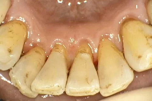 食物、抽菸留下的色素和汙垢 洗牙洗得掉嗎? 食物、抽菸留下的色素和汙垢 洗牙洗得掉嗎?