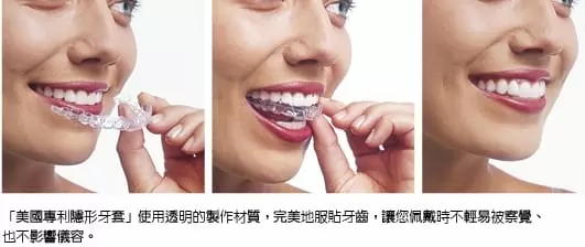 【VOGUE】隱型矯正變美的秘密 【VOGUE】隱型矯正變美的秘密