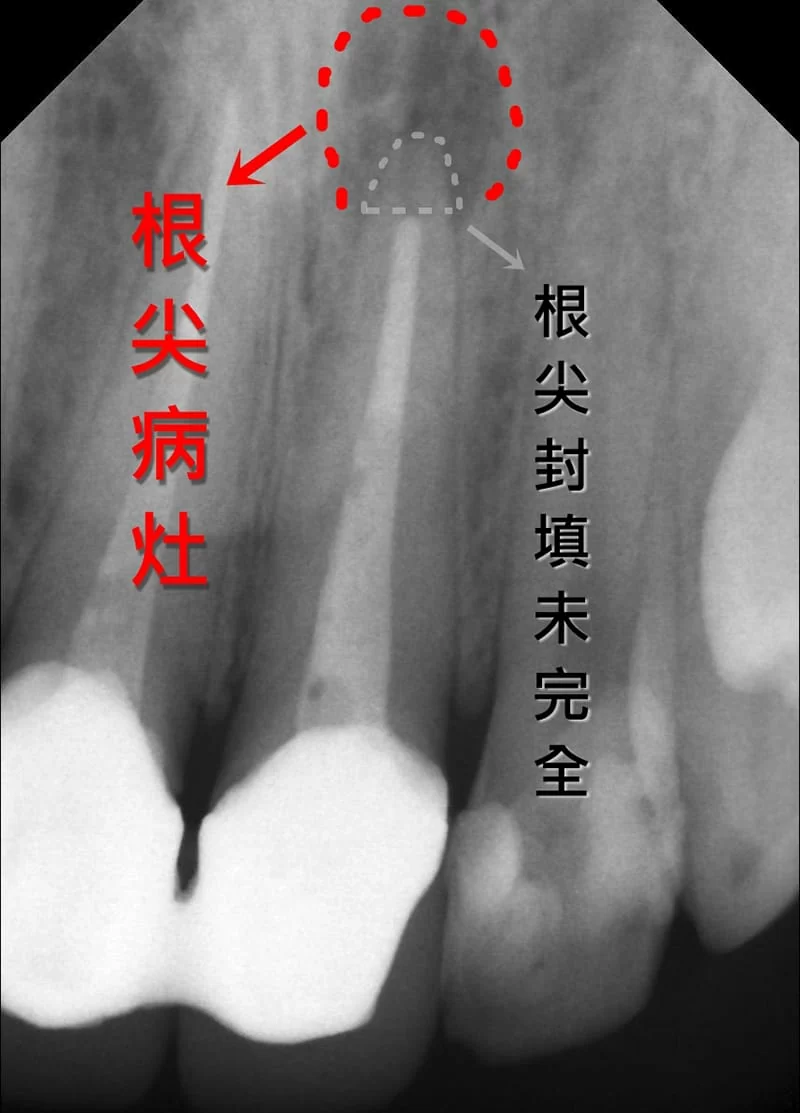 淺談根尖切除術(沈庭帆醫師) 淺談根尖切除術(沈庭帆醫師)