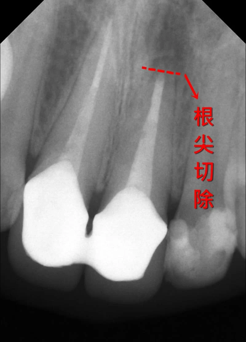 淺談根尖切除術(沈庭帆醫師) 淺談根尖切除術(沈庭帆醫師)