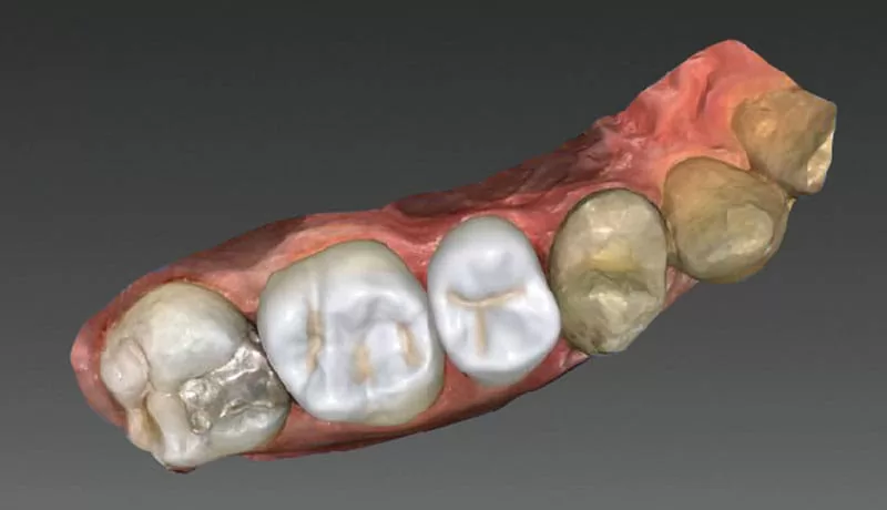 proimages/guiding-teeth-surgery/CerecGuide2_DM-1-04.jpg proimages/guiding-teeth-surgery/CerecGuide2_DM-1-04.jpg
