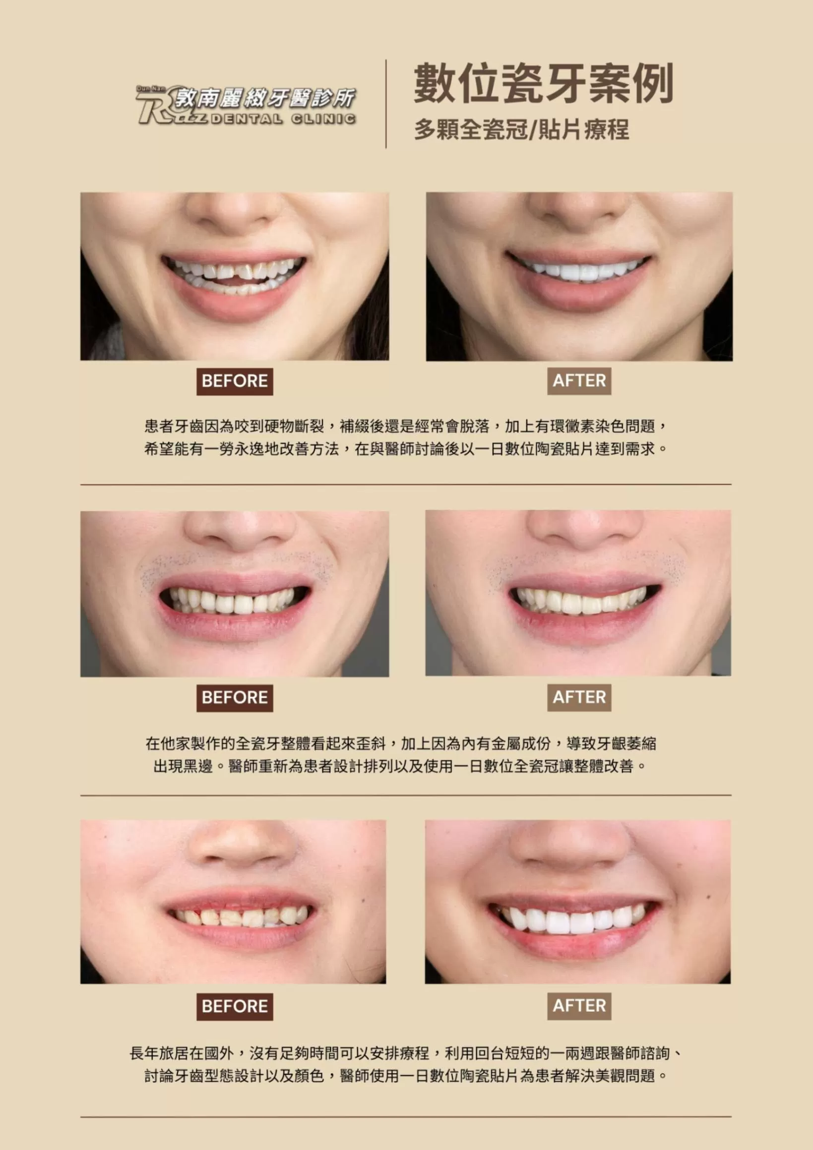 3D齒雕真實效果全記錄 敦麗全瓷案例