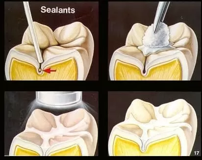 兒童預防蛀牙 - 臼齒溝隙封填 兒童預防蛀牙 - 臼齒溝隙封填