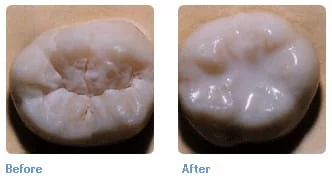 兒童預防蛀牙 - 臼齒溝隙封填 兒童預防蛀牙 - 臼齒溝隙封填