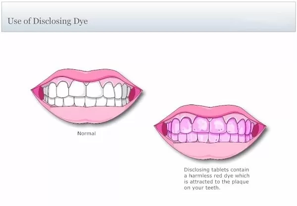 什麼是「牙菌斑」?