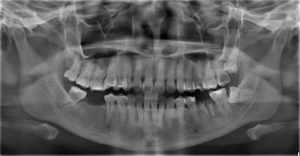 植牙術前口腔完整評估,安全有保障 植牙術前口腔完整評估,安全有保障