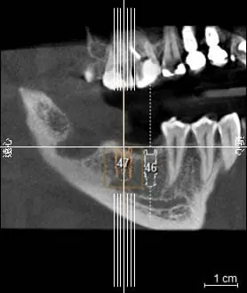 植牙術前口腔完整評估,安全有保障 植牙術前口腔完整評估,安全有保障