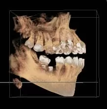 植牙術前口腔完整評估,安全有保障 植牙術前口腔完整評估,安全有保障